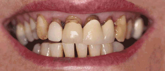 Emax Crown over root filled tooth plus 3 Emax press veneers on the other incisors & white fillings on the eye teeth. Andrea Clarke BDS