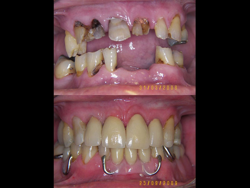 Full Mouth Rehabilitation with lower Chrome Cobalt Partial Denture & upper porcelain crowns Tristan Barker BDS
