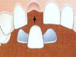 Maryland bridge Milford Dentists