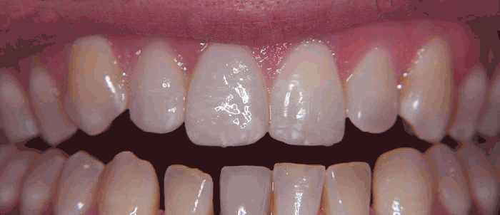 Veneers Matched With Adjacent Teeth