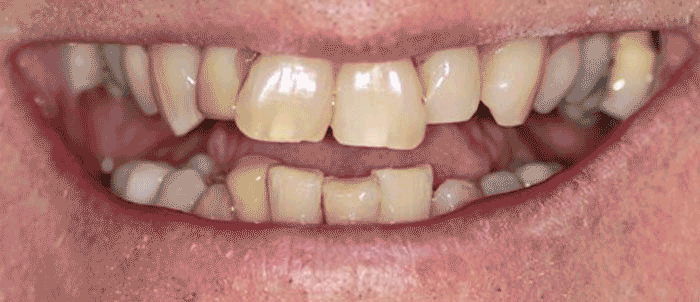 3 of 7 This Chap did not want his teeth to look like he had had any dentistry done - He wanted them to look better/brighter but not Hollywood white. 10 Emax overla Crowns. Andrea Clarke BDS