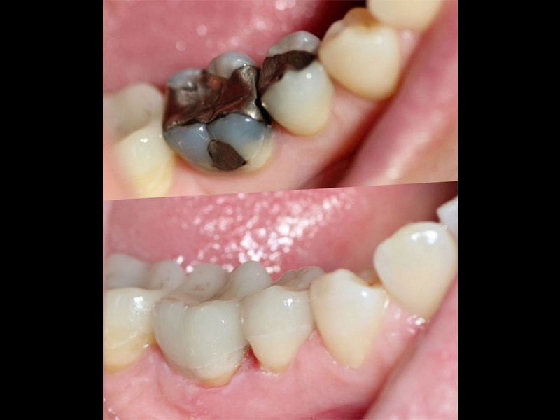 Emax Overlay Crowns replacing old mercury amalgam fillings. Andrea Clarke BDS
