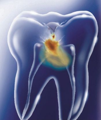 Milford Dentists Diagnodent Decay 