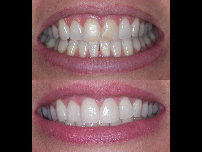 Sameday tooth veneers. This lady did not like the white fillings on her cental incisors. They kept discolouring. She also did not like that her upper right lateral incisor was tilted backwards. I placed 3 sameday emax porcelain veneers which are a long term solution. Andrea Clarke BDS