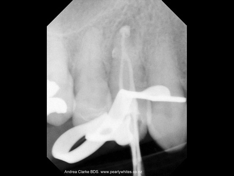 Premolar root filling after