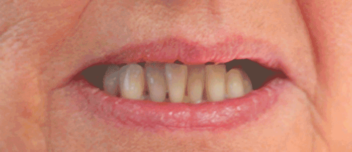 Full Upper Denture. Andrea Clarke BDS