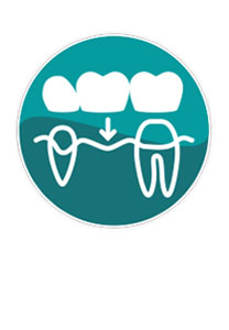 Dental Bridges