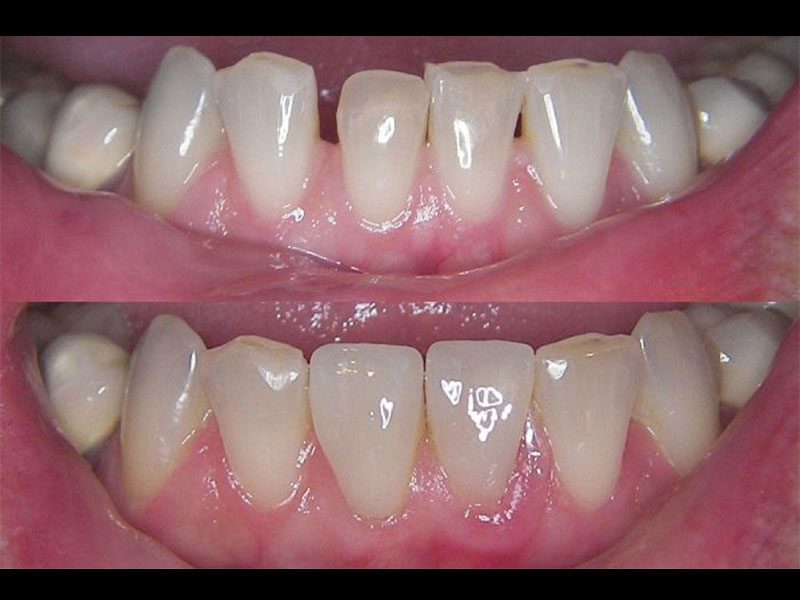 Same Day Emax Porcelain Veneers Andrea Clarke BDS