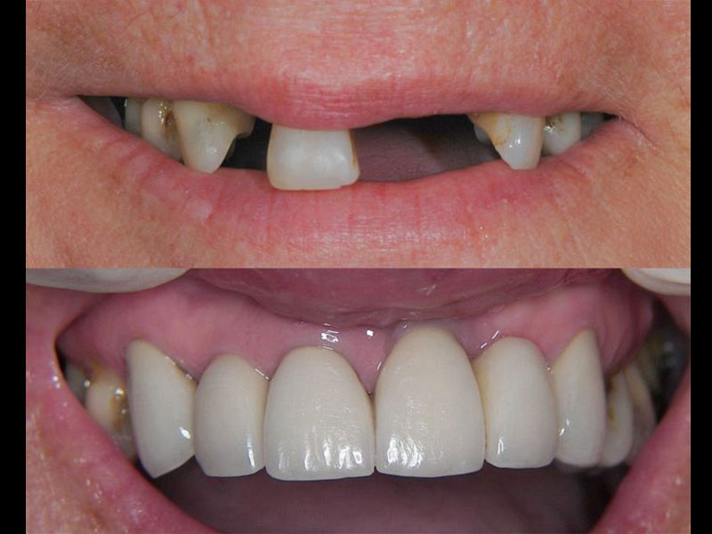 Dental Implants restoring the front upper six teeth. Andrea Clarke BDS