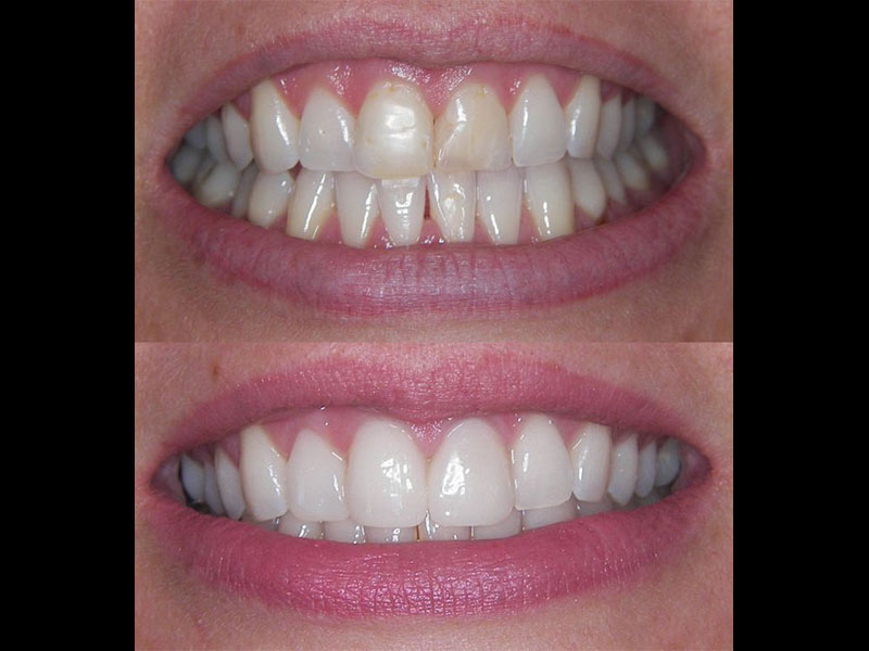 7 of 8 Sameday tooth veneers. This lady did not like the white fillings on her cental incisors. They kept discolouring. She also did not like that her upper right lateral incisor was tilted backwards. I placed 3 sameday emax porcelain veneers which are a long term solution. Andrea Clarke BDS