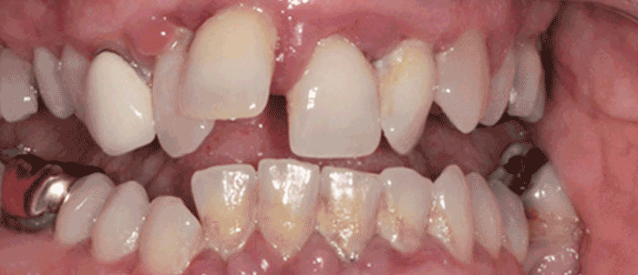 Dental Brdige
