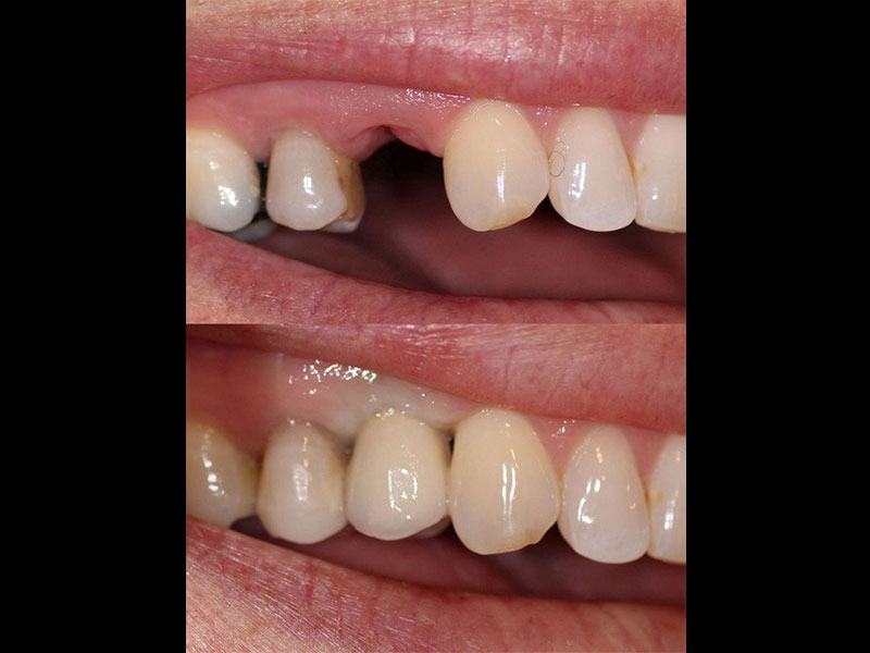 Dental Implant Andrea Clarke BDS 