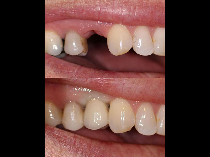 Dental Implant replacing premolar tooth. Andrea Clarke BDS