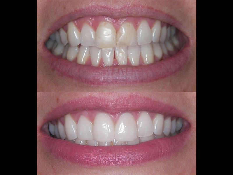 Same Day Emax Porcelain Veneers after tooth whitening Andrea Clarke BDS