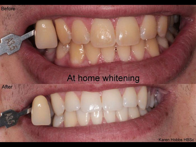 At Home Whitening