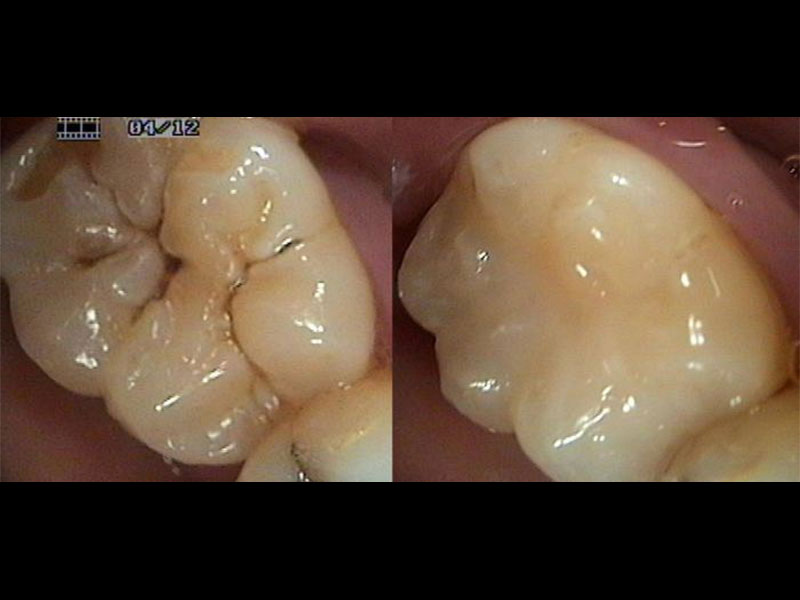 Before Air Abrasion & then after sealant restoration completed. Andrea Clarke