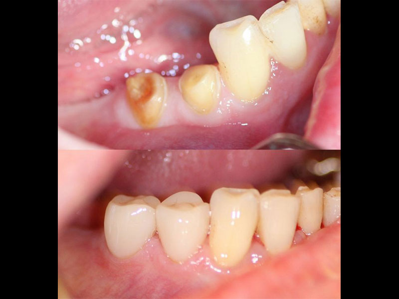 Emax Porcelain Crowns - Same Day Andrea Clarke BDS