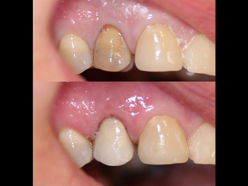 Same Day Emax Porcelain Veneer to mask this ladies discoloured non vital, root filled premolar. The after picture is immediately after boding & the gum will settle nicely over a couple of days. Andrea Clarke BDS