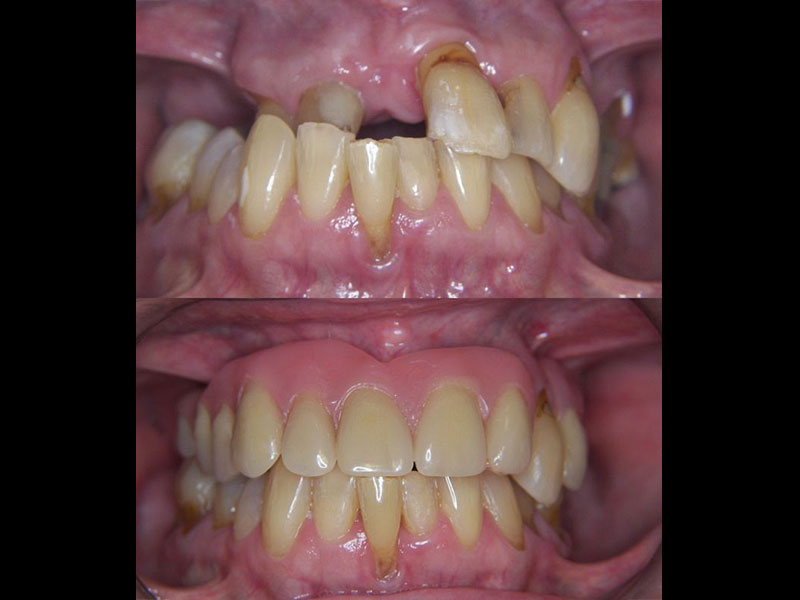 Magnet retained overdentures Tristan Barker BDS