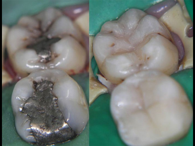 Amalgam Replacement with Composite Resin Fillings Tristan Barker BDS