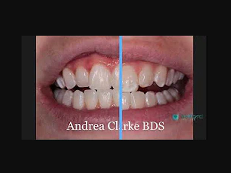 Tooth Whitening