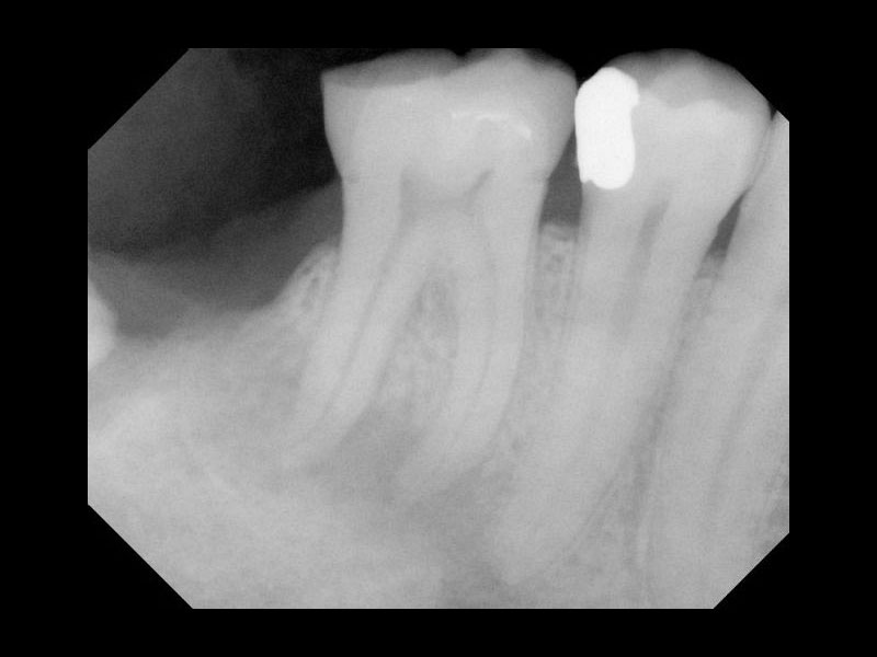 Molar root filling before