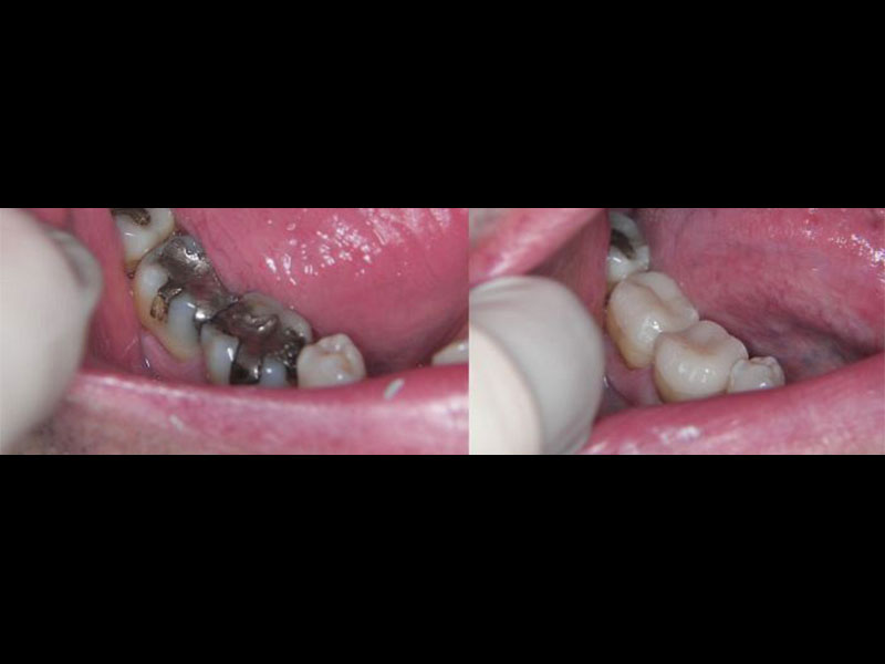 Mercury Amalgam Fillings replaced with Emax Same Day Overlay Crowns Andrea Clarke BDS