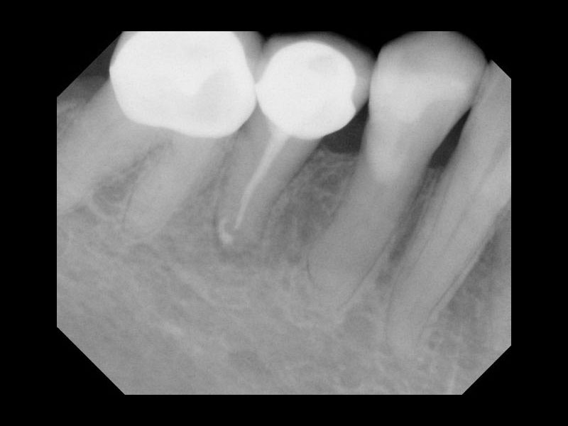 Premolar root filling after