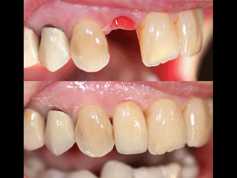 Zirconium Dental Implant with Emax Dental Crown replacing lateral incisor. Andrea Clarke BDS