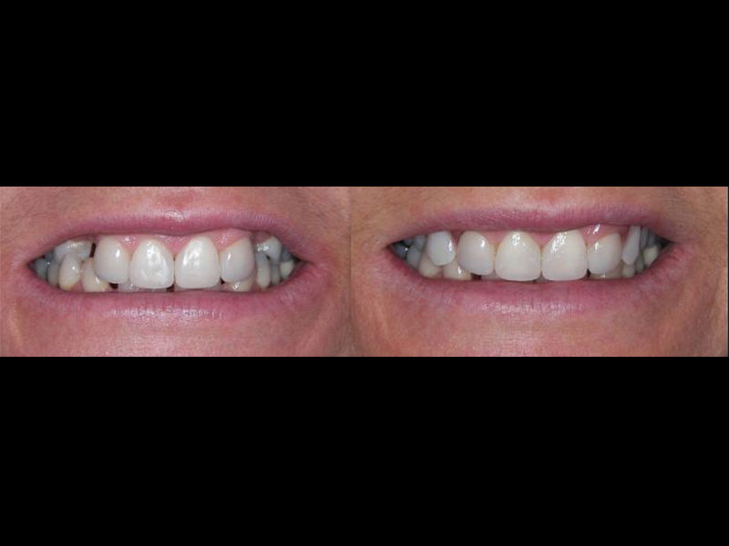 2 Valplast Dentures. One on each side. Andrea Clarke BDS