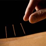 Acupuncture Acupuncture