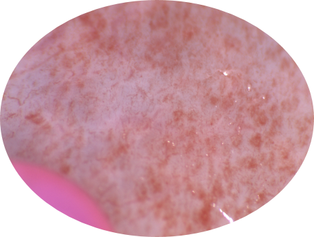 Endometrial surface imaged by the Fertigo mini-hysteroscope