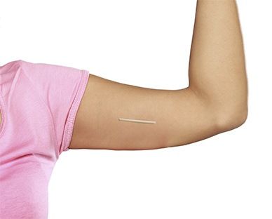 Implanon Insertion & Removal Moorabbin | Contraceptive Implant Melbourne,  VIC