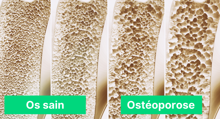 ostéoporose représentation d'un os malade