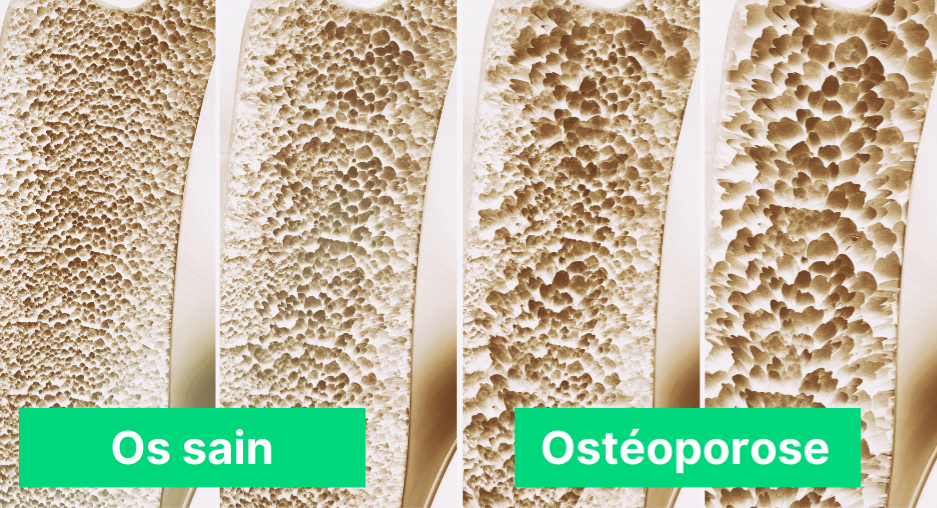 Ostéoporose: comparaison d'un os poreux avec un os sain