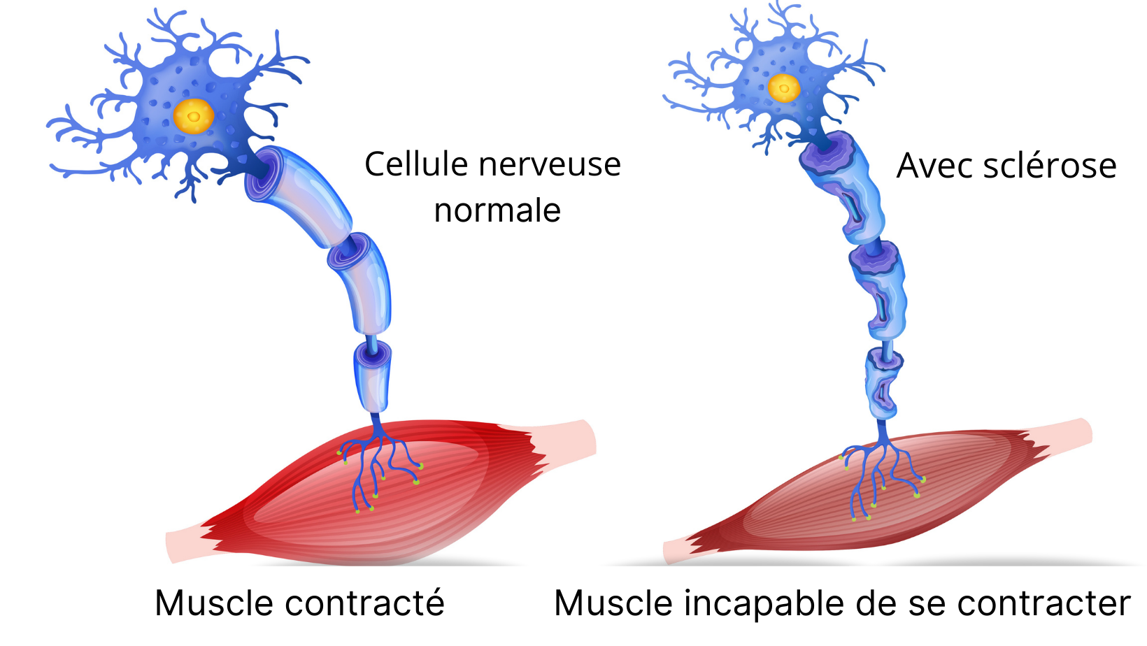 Comparatif d'une cellule nerveuse normale contre une cellule sclérosée par la SLA. Les muscles ne répondent pas aux stimulations de la cellule nerveuse.