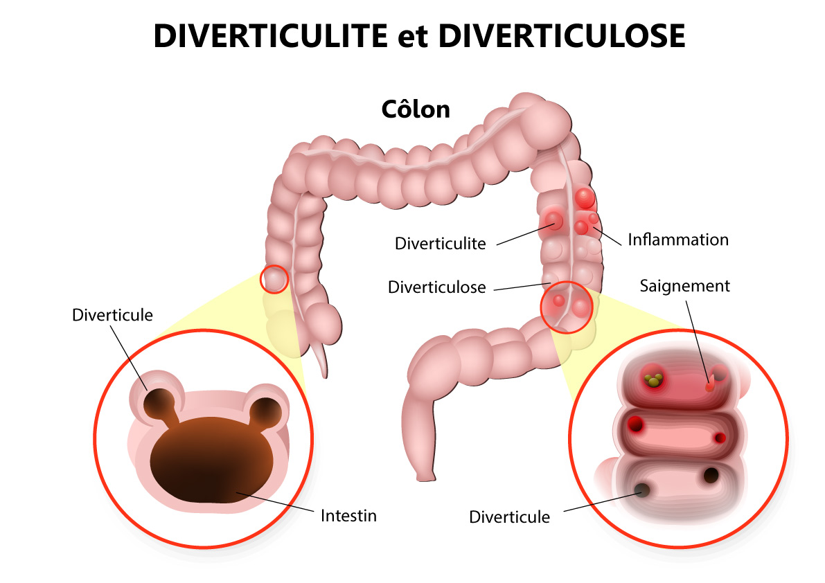 Schéma de la diverticulite et d'une diverticulose du côlon