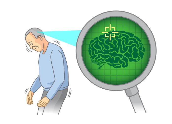 Tremblements et posture courbée : deux des signes avant-coureurs de la maladie de Parkinson