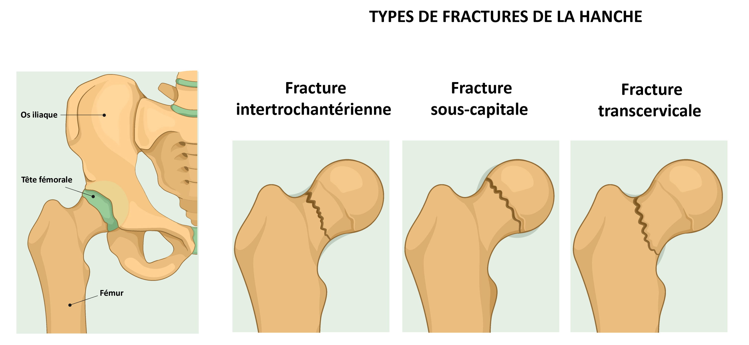 Fractures du col du fémur chez la personne âgée | Cap Retraite