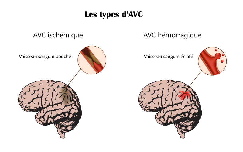 Le cerveau et ses lésions selon les deux types d'AVC