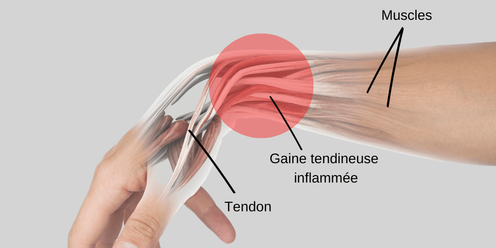 Tendinite de de Quervain - Tendinite du poignet à la base du pouce