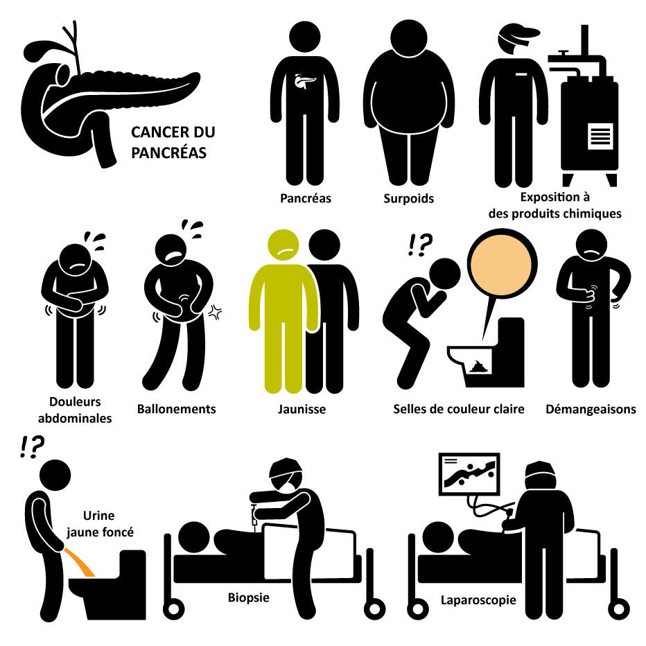 Cancer du pancréas : symptômes et causes- Cap Retraite