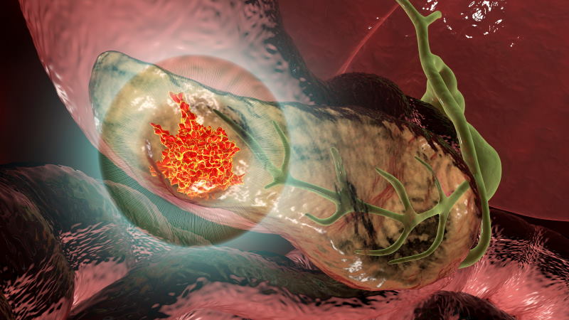 Cancer du pancréas : symptômes et causes- Cap Retraite