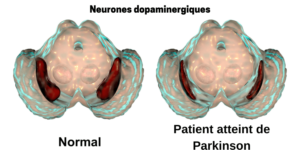 Atteintes des neurones dopaminergiques d'un patient Parkinson