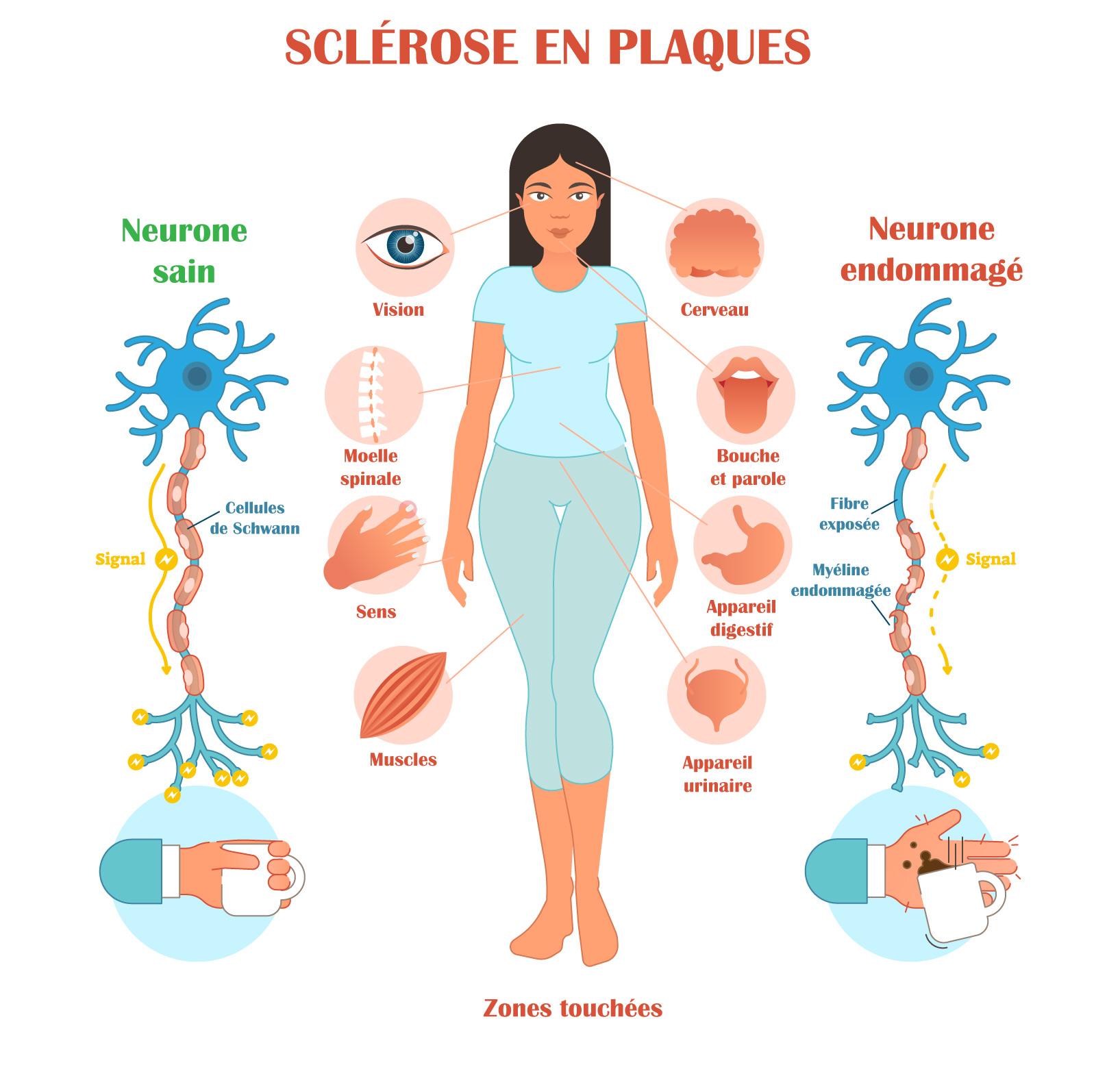 Schéma des symptômes de la sclérose en plaque et de l'effet sur les neurones