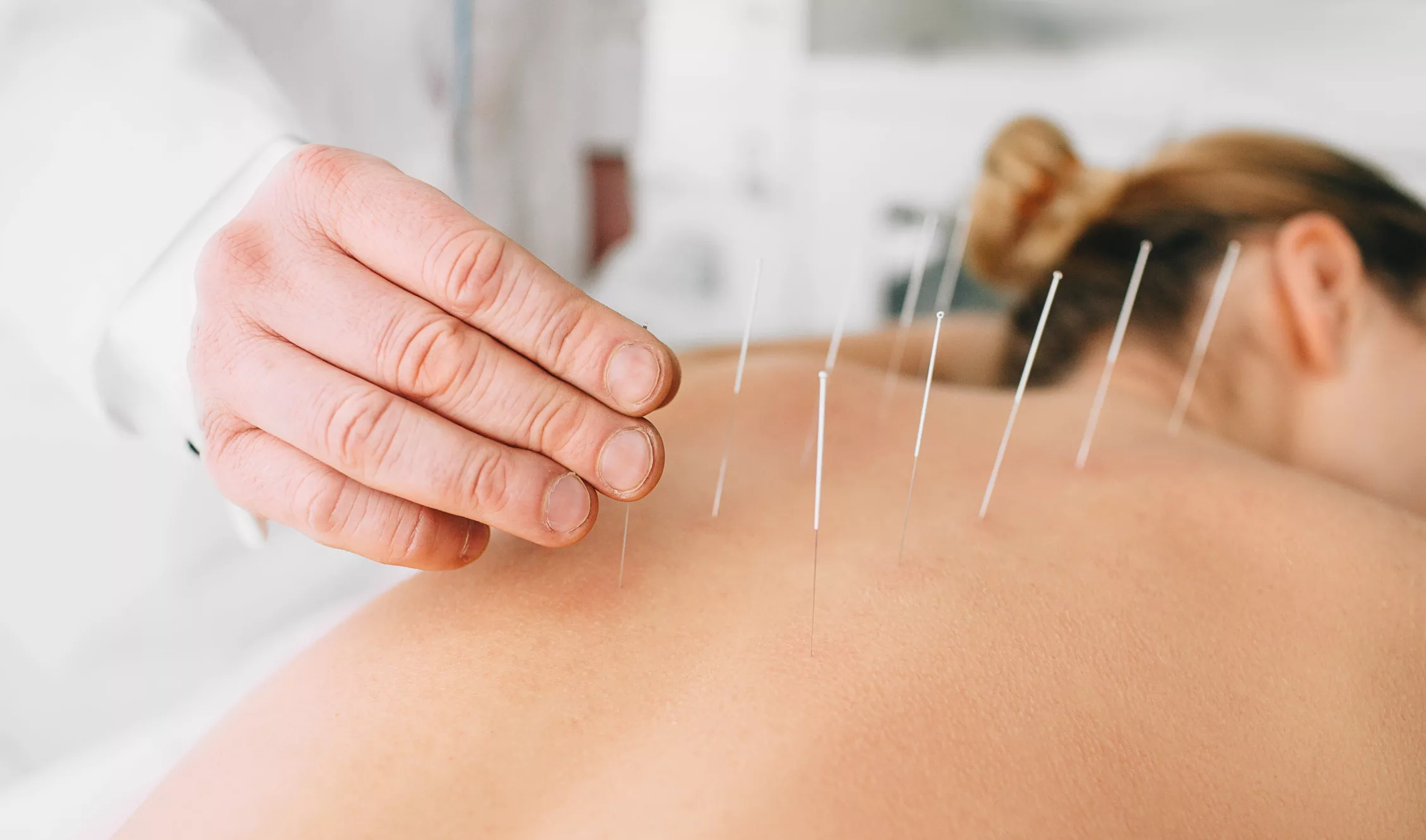 Everything You Need to Know About Acupuncture: The History, How it Works and the Benefits