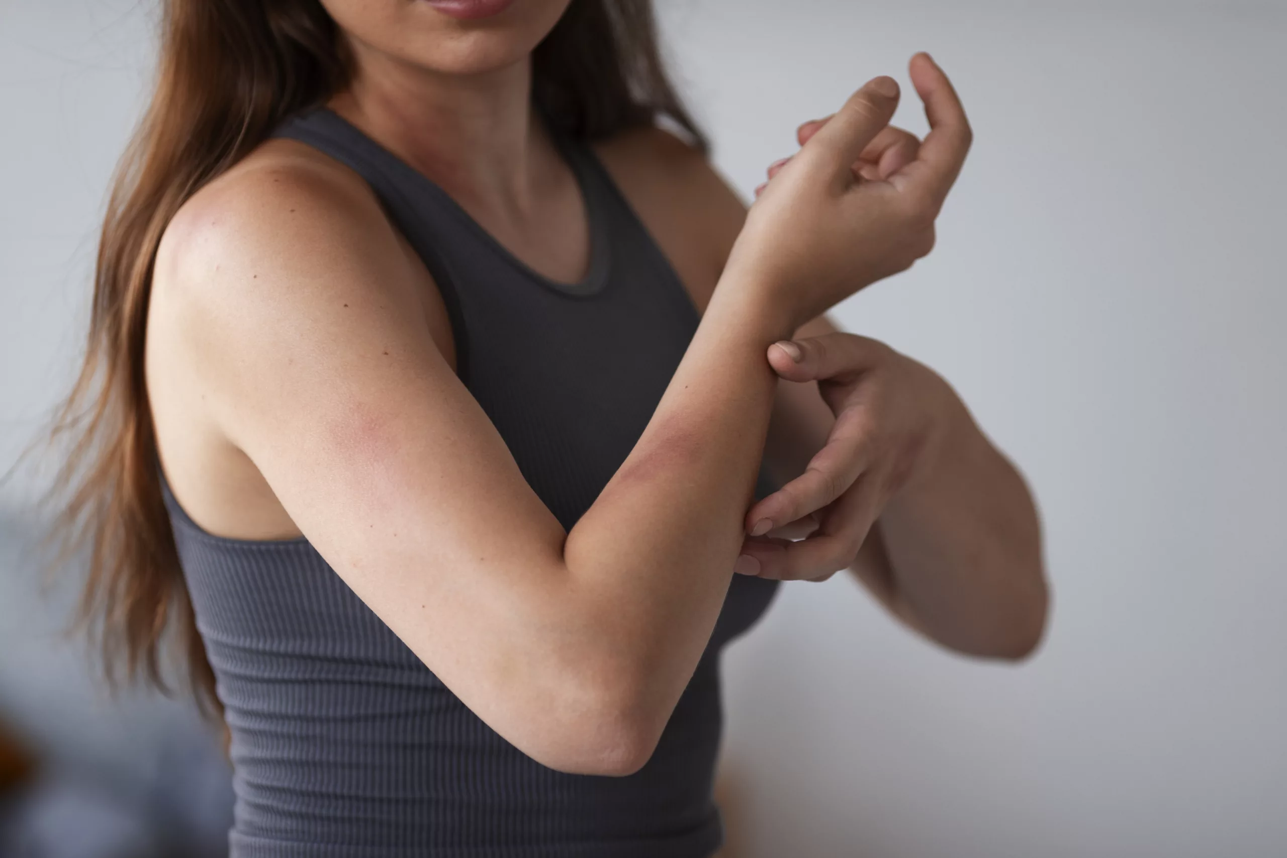 Psoriasis: Signs, Symptoms, Treatments, and More