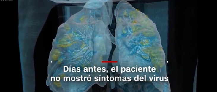 Un video en 3D revela cómo ataca el covid-19 a los pulmones