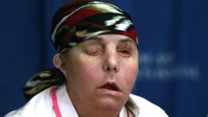 Realizan un segundo transplante de cara a una mujer en EUA