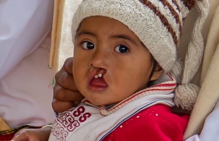 Cleft lip girl with red dress in Syria